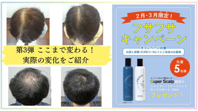 【堺東駅】薄毛の悩みを解消「最初は半信半疑でした」実際の変化がこちら！さらにいまなら体験がお得になるキャンペーン中：